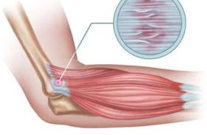 Lateral elbow tendinopathy