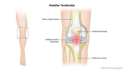 Patellar tendinosis