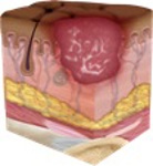 Loss of the epidermis