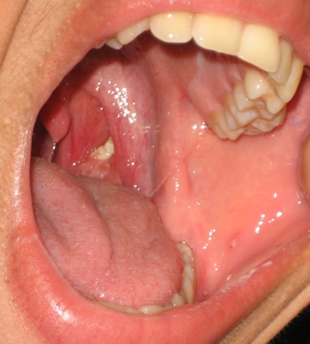 Picture of left tonsil showing tonsil stone
