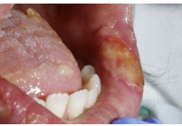 Mucosal pressure ulcer