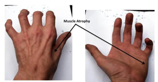 Muscle atrophy in hand