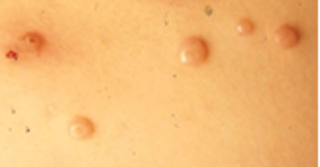 Flesh coloured or pink papules with umbilicated centre image
