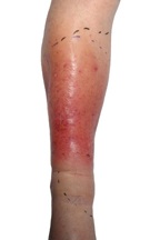 Acute cellulitis intact skin