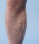 Varicose veins with no skin complications