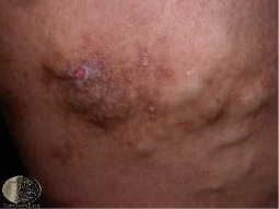 Varicose eczema picture 2