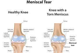 Meniscal tear
