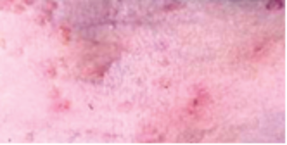 Resolving molluscum contagiosum image