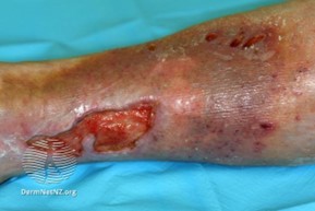 Venous ulceration picture 1