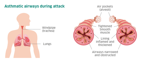 Image of airways during an attack