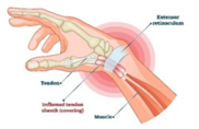 De Quervain's tenosynovitis