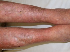 Lipodermatosclerosis picture 2