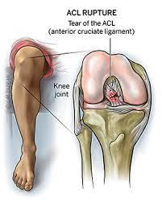 ACL rupture