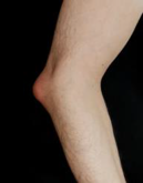 Olecranon bursitis