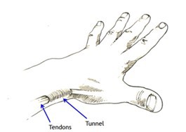 Dequervains syndrome