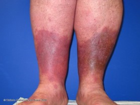 Lipodermatosclerosis picture 1