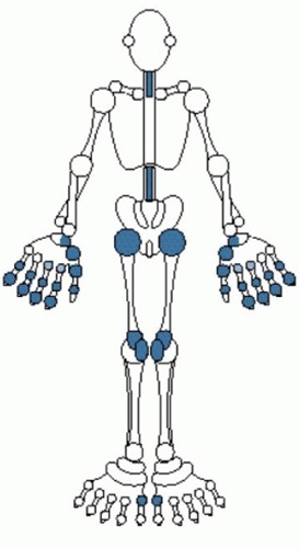 Diagram of typical joints affected in osteoaethritis