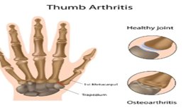 OA thumb