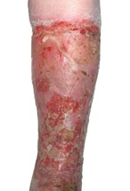 Acute cellulitis broken skin