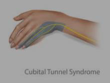 Cubital tunnel syndrome